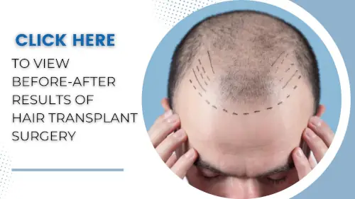 view-before-after-results-of-hair-transplant