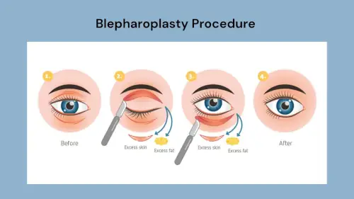 Image explaining Blepharoplasty Procedure