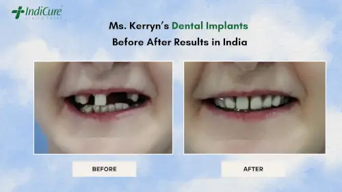 dental-implants-in-india-treatment-results