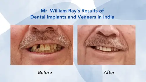 Comparison image for Dental Implants in India Before After results