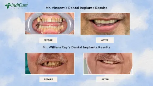 dental-implants-treatment-in-india-before-after