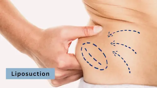 liposuction-low-risk-cosmetic-surgery-procedure