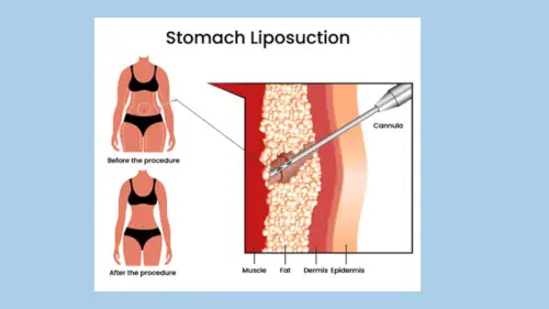 Stomach Liposuction in India