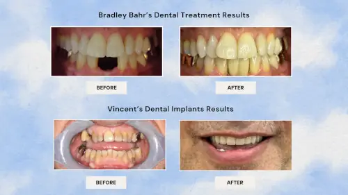 dr-anand-krishnamurthy-dental-treatment-before-after-1