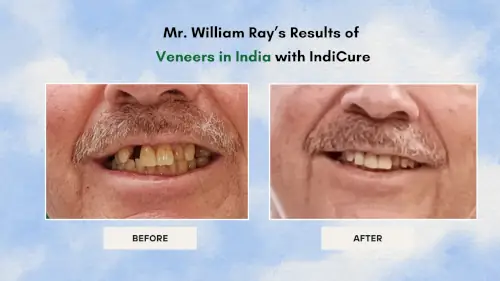 dr-chirag-desai-dental-treatment-before-after