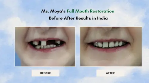 dr-chirag-desai-full-mouth-restoration-treatment-results