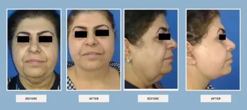 dr. Vipul Nanda's plastic surgery before after results 1