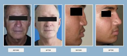 dr. Vipul Nanda's plastic surgery before after results 2