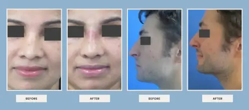 dr. Vipul Nanda's plastic surgery before after results 3