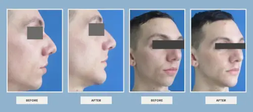 dr. Vipul Nanda's plastic surgery before after results 4