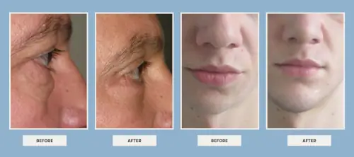 dr. Vipul Nanda's plastic surgery before after results 5